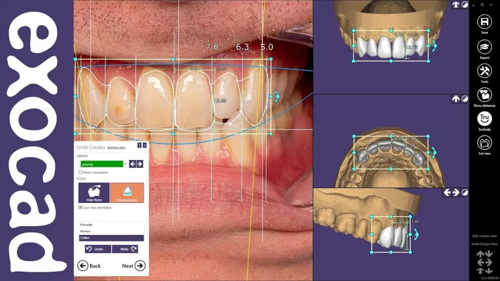 Como usar o programa Exocad na Odontologia digital